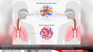 World TB Day: A Global Call to Action Against Tuberculosis and Multidrug-Resistant Strains